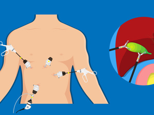 肝硬化顽固性腹水治疗方法