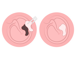 有宫腔黏连会怀孕吗