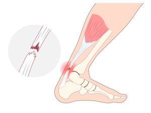 跟腱断裂多久好