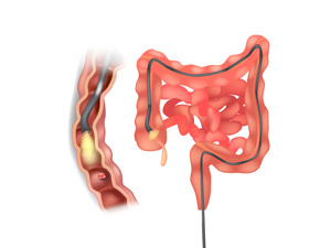 结肠息肉cp1什么意思