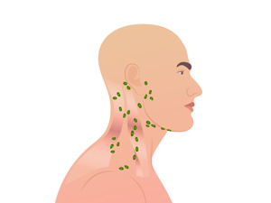 颈部淋巴结如何区分良性恶性