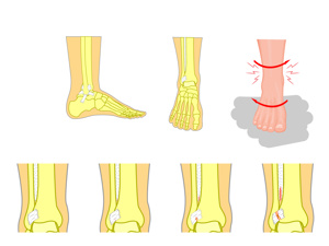 内脚踝撕脱骨折