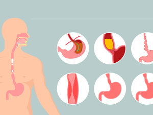 反流性食管炎的主要症状是什么意思