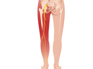 腰突坐骨神经痛