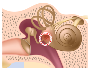 前庭神经_内耳淋巴液流动异常