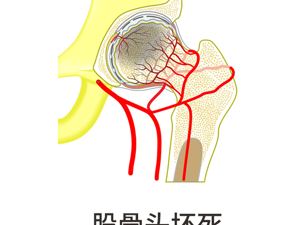 患者_骨股骨头坏死