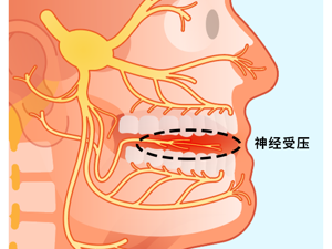 神经受压