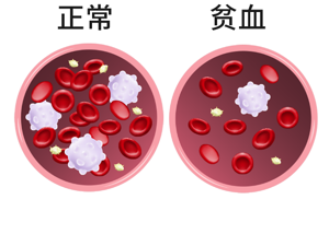 患者_贫血