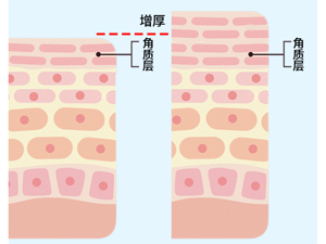 角质层增厚