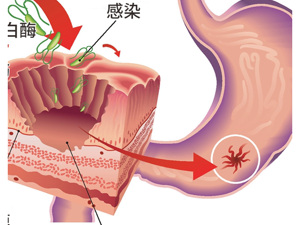 幽门螺杆菌感染