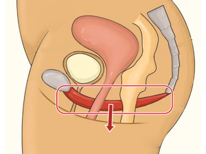 盆底肌肉_阴道松弛