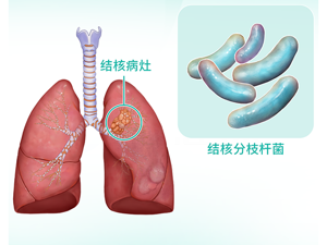 结核菌