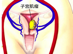 本月排名!长沙hpv检查哪家医院好“推荐总榜”HPV-58型感染者分享:中药治疗宫颈病变的真实体验
