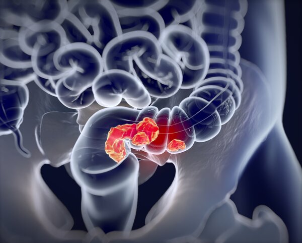 Cancers：dMMR/MSI转移性结直肠癌（mCRC)治疗失败后使用传统治疗（CT，化疗联合或不联合靶向治疗）治疗的疗效