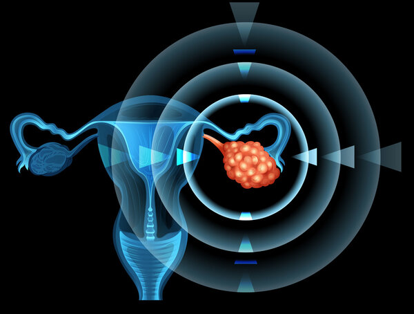 Br J Cancer：他汀类药物的使用与卵巢癌患者存活率的关联性研究