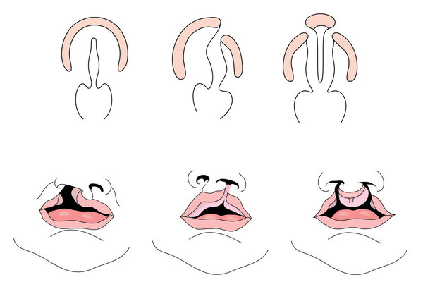 唇裂手术后会有什么后遗症