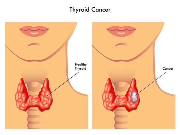 Thyroid：体重指数与甲状腺癌风险的关系