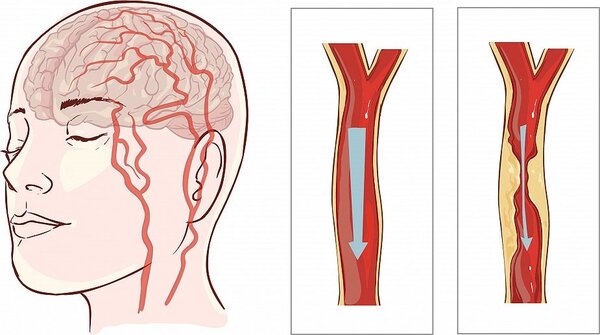 Stroke：急性前循环缺血性卒中血管内再通后延迟神经系统改善的预测因素