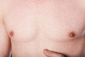 荨麻疹与艾滋病症状有什么区别