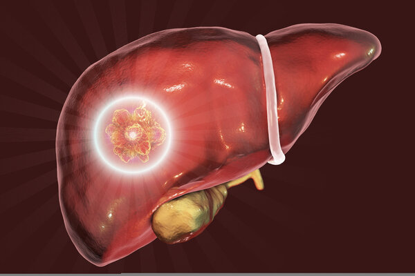 Clin Gastroenterology H: 中国大队列人群中非酒精性脂肪肝与癌症发生的关系