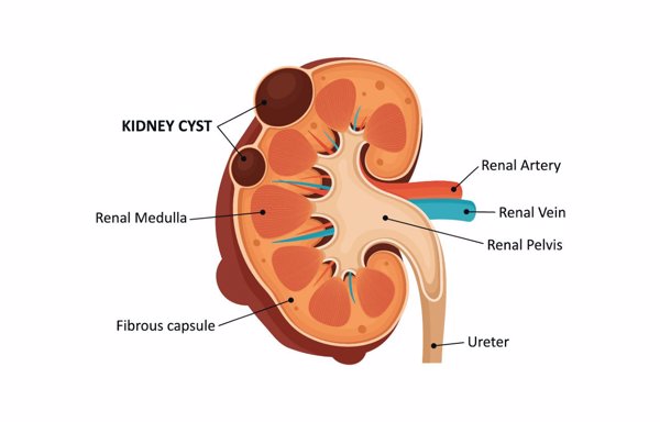 左肾囊肿什么原因引起