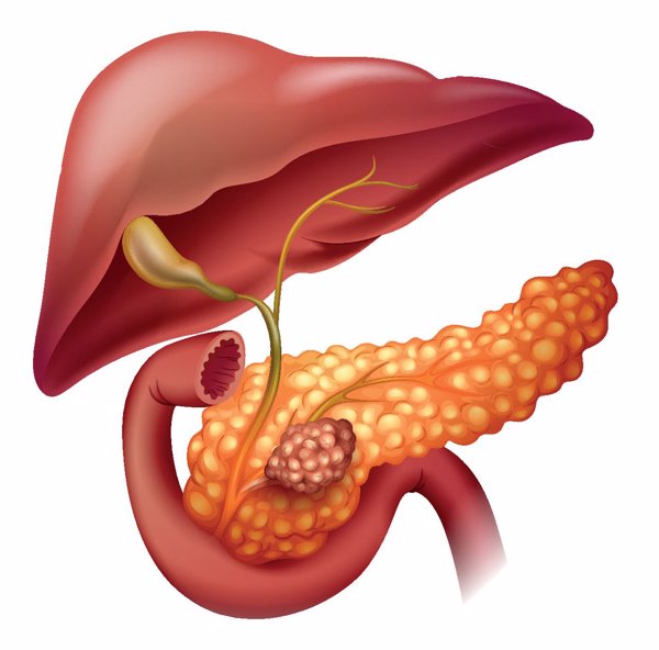 胰腺内分泌肿瘤与胰腺癌是一回事吗