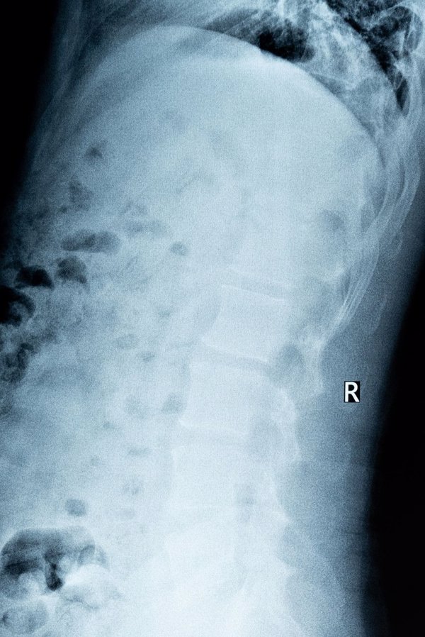 腰5椎体双侧椎弓峡部断裂严重吗