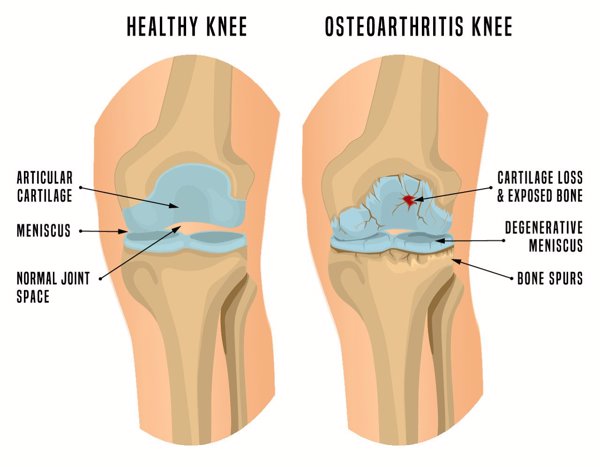 骨性关节炎是怎么回事
