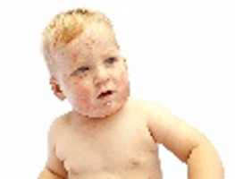 荨麻疹免疫力低吃什么好的快