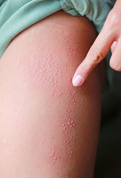 荨麻疹皮肤刺痛瘙痒用什么药膏好