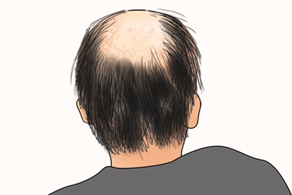 抽烟会脱发吗
