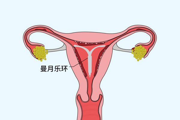 上曼月乐环会引起乳腺疾病吗