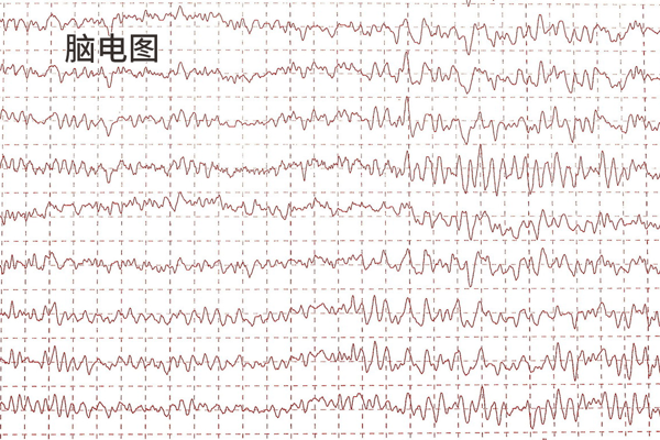 儿童局灶性癫痫青春期会自愈吗