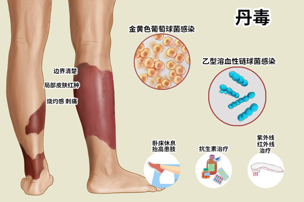 丹毒的最坏结果会截肢吗