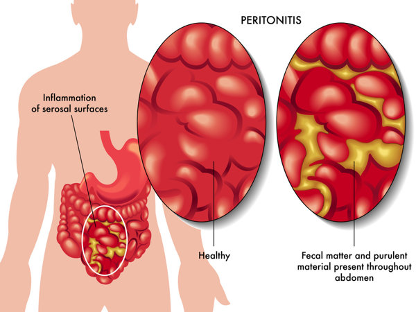 阑尾导致腹膜炎
