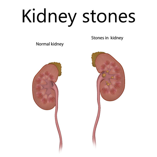 吃了肾石颗粒排石前兆是什么感觉