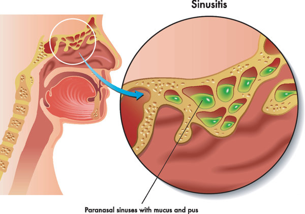 三岁孩子鼻窦炎症状