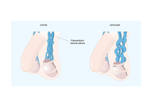 男性疝气有什么危害