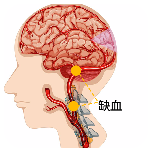 老年人蛛网膜下腔出血严重吗