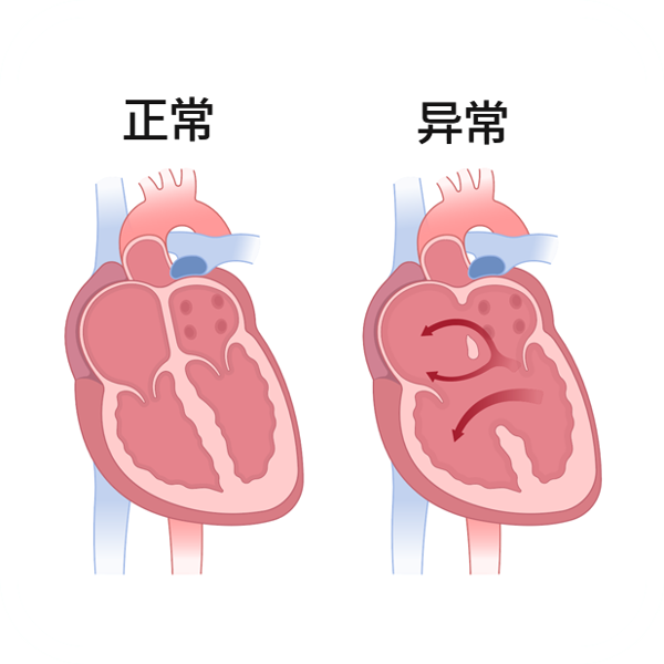 瓣膜修复后能和正常人一样吗