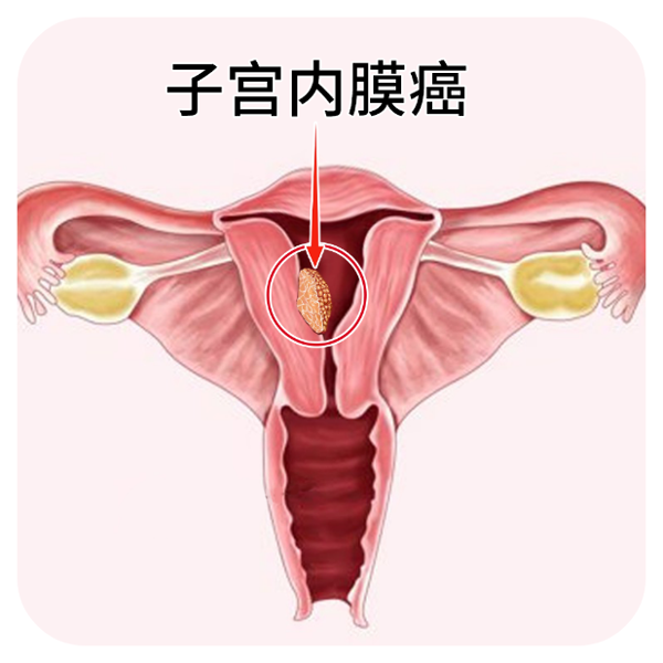 子宫肉瘤彩超误诊15例