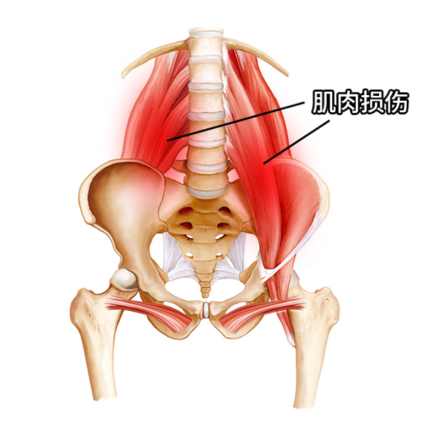 髋内旋是怎么造成的