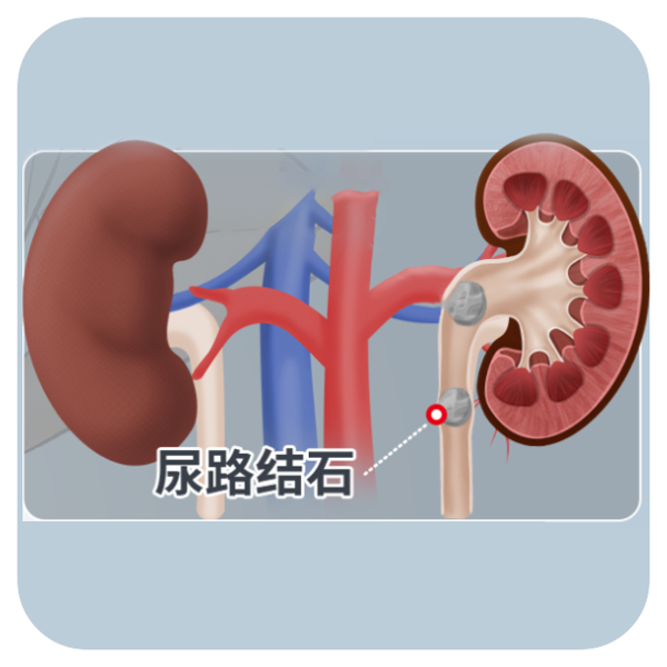 输尿管结石0.4cm能排出来吗