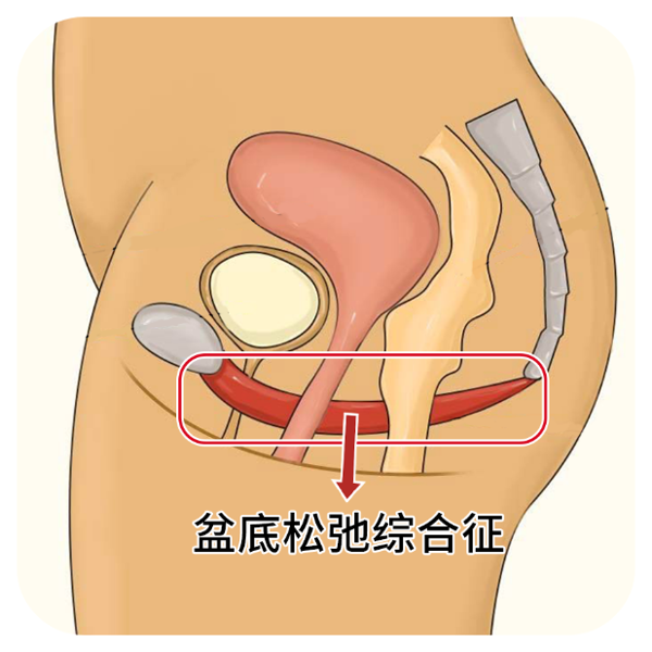 盆底肌下垂是什么症状