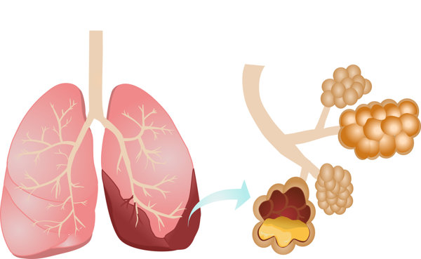 甲状腺转移肺存活率高吗