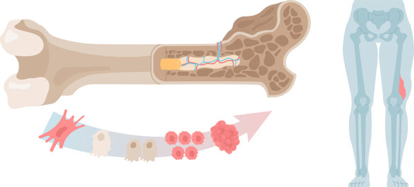 骨癌是怎么回事?