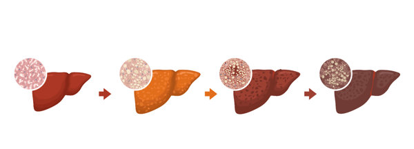 早期肝纤维化如何逆转