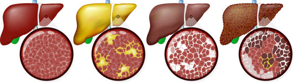 纤维化肝是什么意思