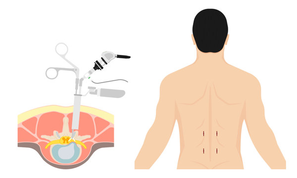 射频消融治疗腰椎间盘突出症