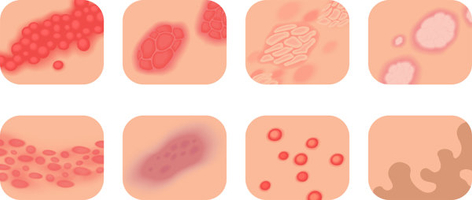 荨麻疹是不是艾滋病毒